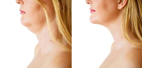 Explore Non-Surgical Neck Tightening: A Complete Guide to Modern Skin Firming Treatments